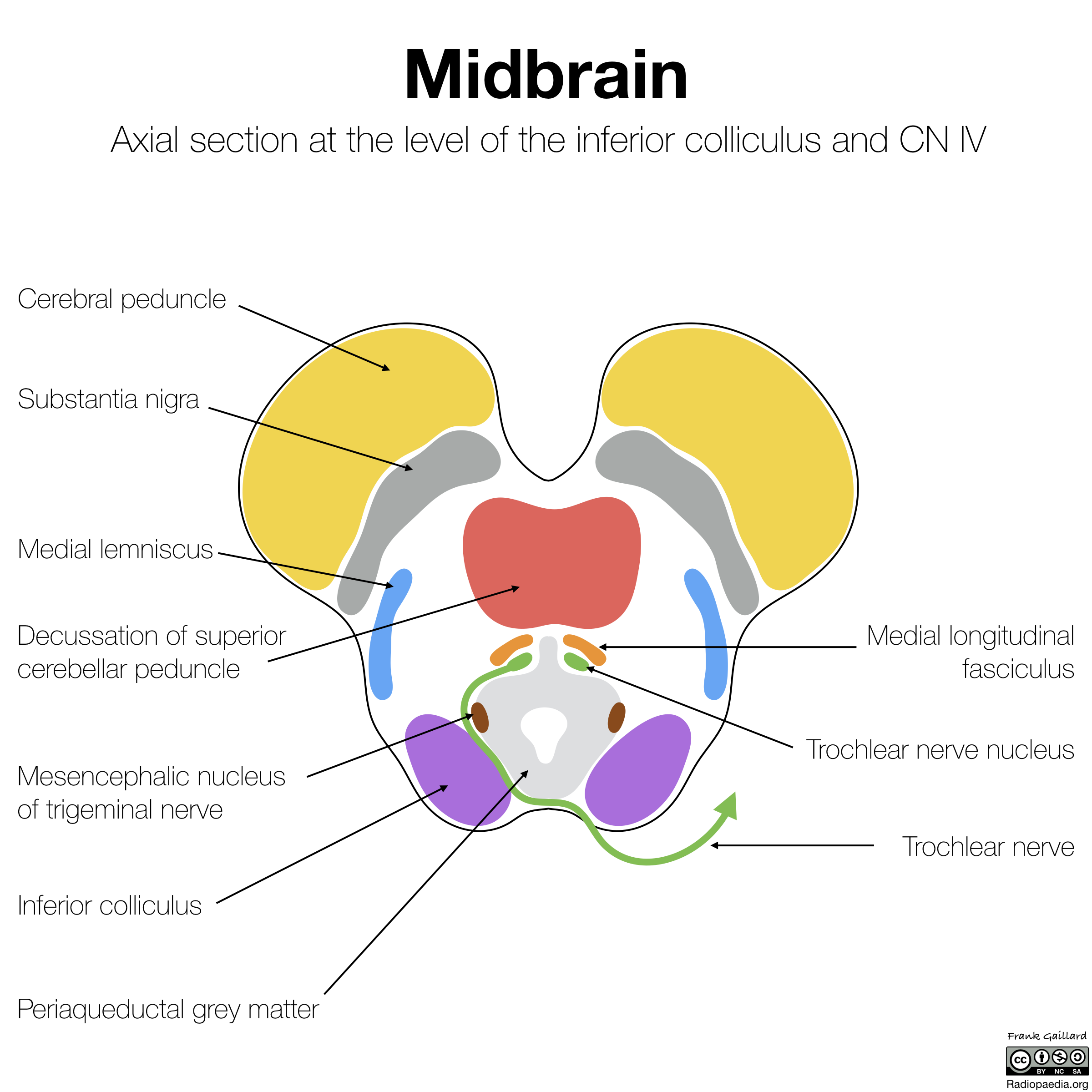 Radiopaedia Drawing Midbrain At Level Of Inferior Colliculus And 